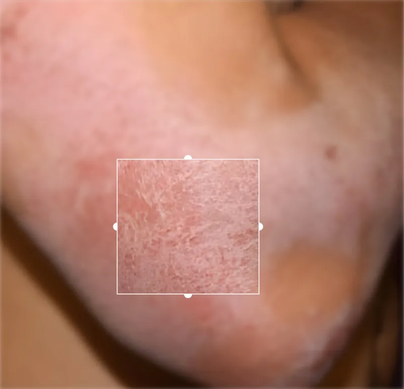 Eczema